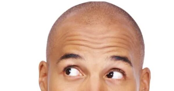 5 genius ways to hide a bald patch