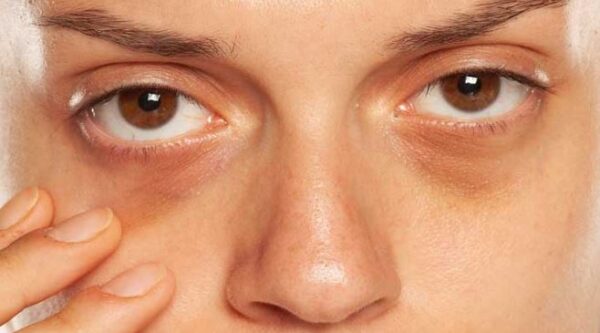 5 health problems that cause dark circles around eyes